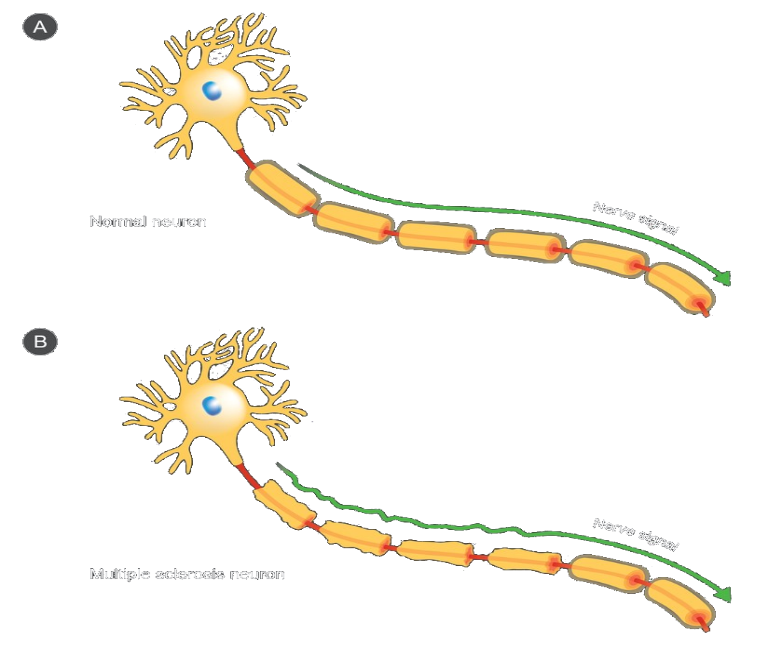 Diagram comparing a normal neuron and a multiple sclerosis neuron with nerve signal labels.